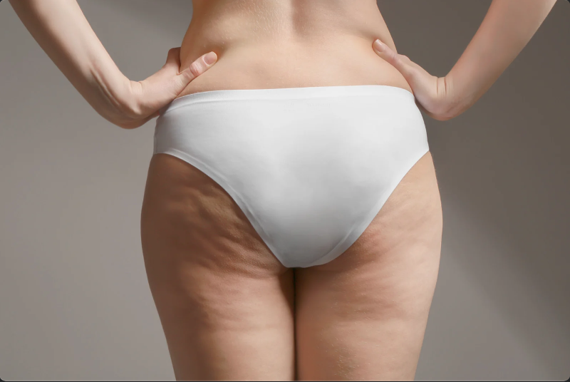 Il mito della cellulite: il difetto inesistente dal business miliardario